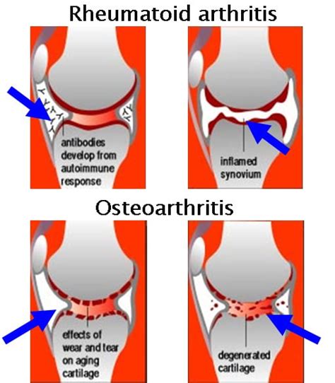 Inflammatory Arthritis Of The Hip Robert Howells