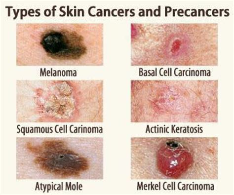 Melanoma Skin Cancer Skin Cancer Melanoma Non Melanom Vrogue Co