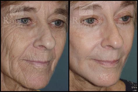 Chemical Peel Before After Photos Rejuva Center 50 Off