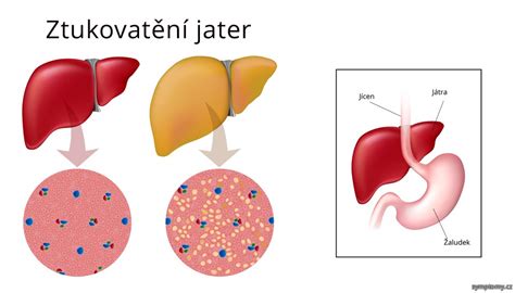 Bežné príznaky a príznaky zahŕňajú dýchavičnosť, dýchavičnosť a kašeľ. Zvětšení jater - příznaky a léčba