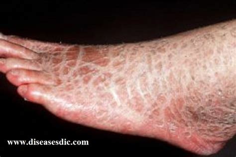 Ichthyosis Causes Risk Factors And Treatment