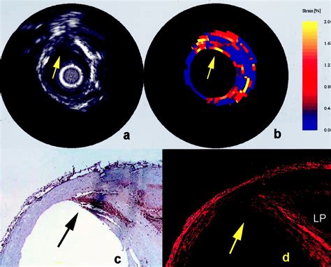 Characterizing Vulnerable Plaque Features With Intravascular