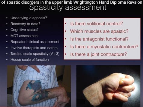 Management Of Spasticity In The Upper Limb —