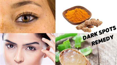 You Need Turmeric And Aloe Gel For Your Stubborn Dark Spots And Marks