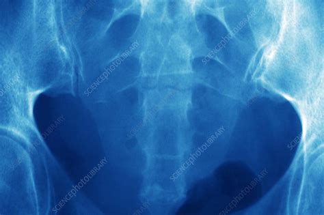 Pelvic Spine Fracture X Ray Stock Image M Science Photo