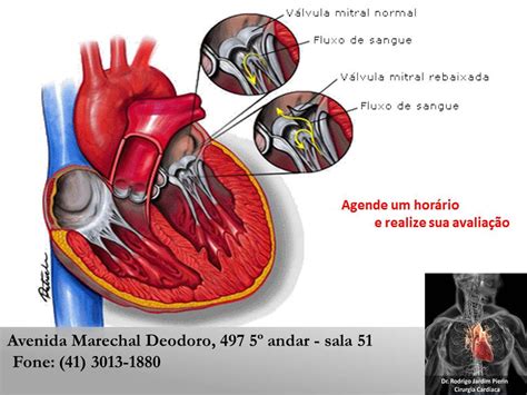 Regurgitação Mitral Discreta Sintomas