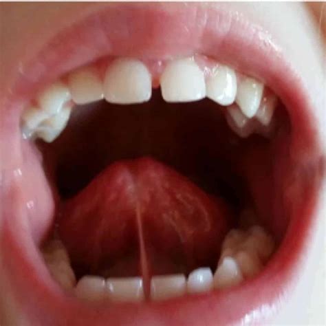 30 Tongue Tie Signs And How To Treat Them Your Kids Table