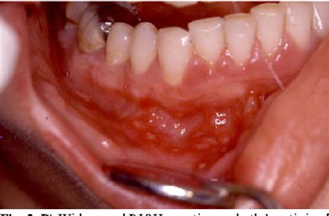 Have been exposed herpes simplex virus is hard to diagnose. Figure 3 from Recurrent intraoral HSV-1 infection: A ...