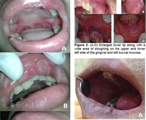 Albothyl adalah obat luar yang bekerja sebagai pembunuh kuman dan mencegah infeksi (antiseptik), hemostatik, dan juga astringent. Pemakaian Alboltil - Diskes Jangan Pakai Albothyl Lagi ...