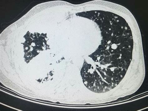 With locally advanced tumors, it is important to distinguish between t3 (potentially resectable) and t4 (technically unresectable) disease. Circumferential irregular pleural thickening with areas of ...
