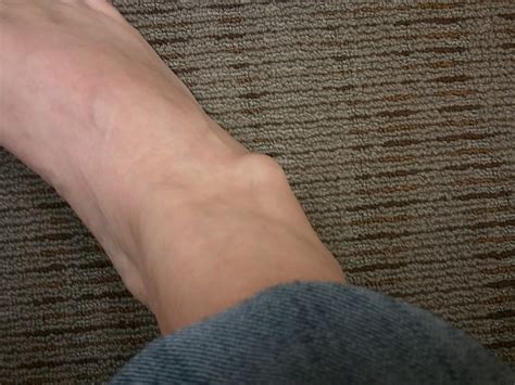 It is understandable to want to seek care promptly for this condition as it can easily impact your mobility at work and during your free time. Why Do You Have Lump on Your Ankle? | MD-Health.com