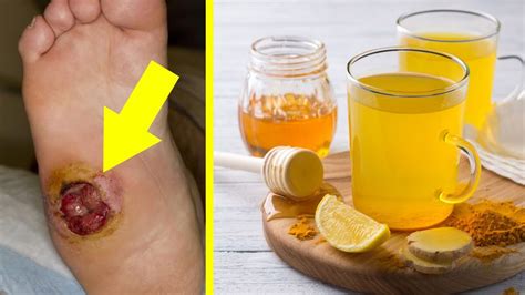 How To Get Rid Of Bed Sores Fast At Home Home Remedies For Bed Sores