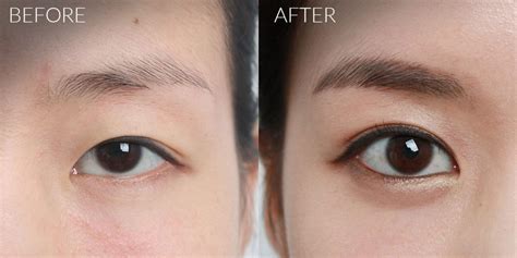 Asian Double Eyelid Surgery In London Perfect Eyes Ltd