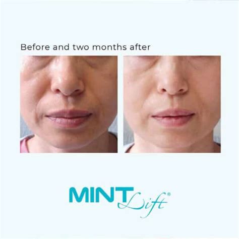 Mint Thread Lift Instant Non Surgical Facelift Skin Renu