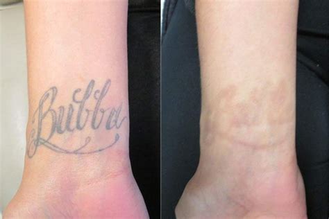 Laser Tattoo Removal Contour Dermatology
