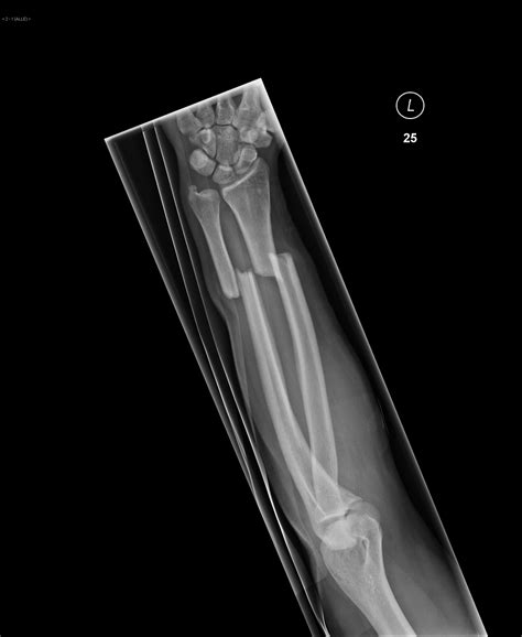 Forearm Fracture Image