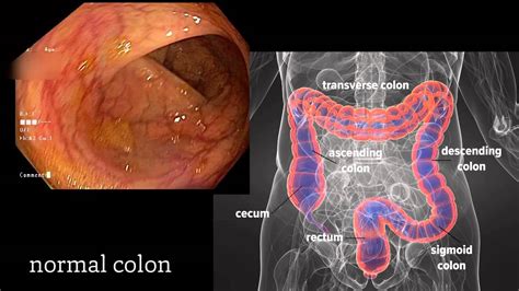 Colonoscopy A Journey Though The Colon And Removal Of Polyps Youtube