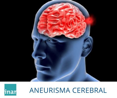 El aneurisma cerebral es una protuberancia en forma de globo que surge en una o más arterias cerebrales, producto de un debilitamiento de la pared del vaso. Aneurisma Cerebral - INAR