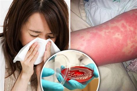 Urgent Health Warning As Scarlet Fever Cases Double Across Uk Daily Star