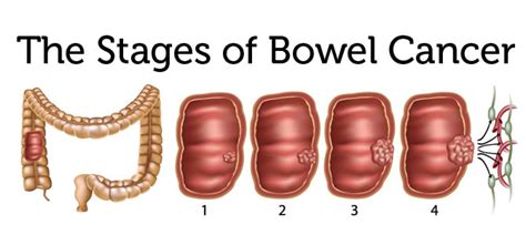 Colon cancer (colorectal cancer) and irritable bowel syndrome (ibs) have common symptoms and signs, for example, constipation, the feeling of still having to go to the bathroom after a bowel movement, and changes in bowel movements. What is Bowel Cancer?