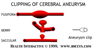 A number of factors can contribute to weakness in an artery wall and increase the risk of a brain aneurysm or aneurysm rupture. Untitled Document www.rnceus.com