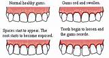 Sore Gums And Teeth On One Side Images
