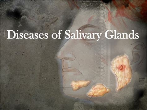 Ppt Diseases Of Salivary Glands Powerpoint Presentation Free