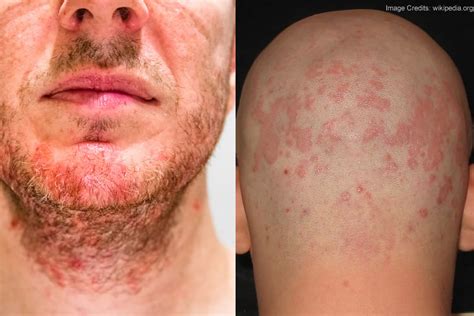 Dermatite Seborroica Cause E Sintomi Trattamenti Utili