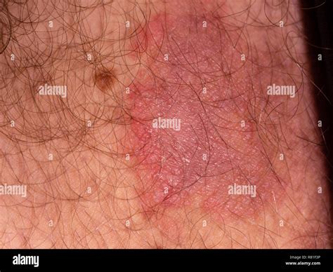Infección Micótica De La Piel Del Muslo Masculino Fotografía De Stock Alamy