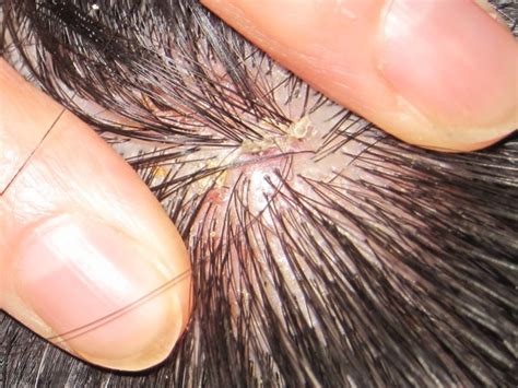 I spent more time in the shower picking strands. Natural and Alternative Treatments for Scalp Psoriasis ...