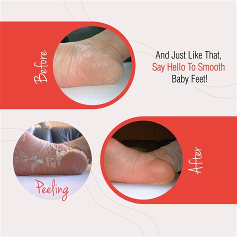Before & After - Baby Foot
