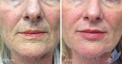 Fine Lines And Wrinkles Before And After Gallery Austin Clinic