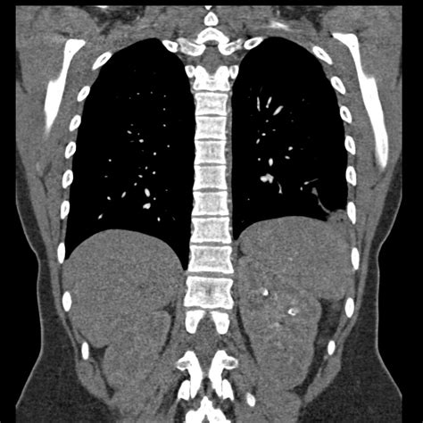 Geralmente, ocorre quando um trombo venoso (sangue coagulado de uma veia) se desloca de seu local de formação e viaja, ou emboliza. BLOG SCAN - RA Radiologistas Associados: TROMBOEMBOLISMO ...