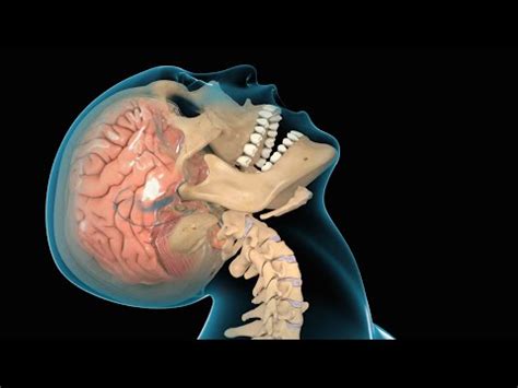 They can be used to identify players at risk and treat them early, before serious effects occur. secondary injury after concussions -Concussion TBI PTSD ...