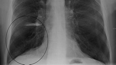11 Normal Chest X Ray Vs Copd Us Ron J Moen