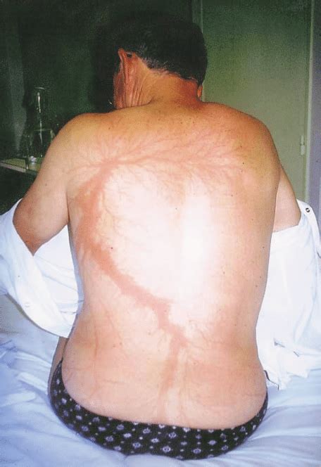 Lichtenberg figures caused by lightning strike in a 54-year-old man ...