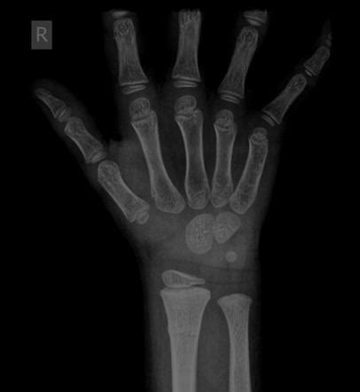 Torus Fracture Radiology Reference Article Radiopaedia Org