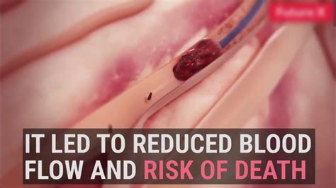 How To Remove Blood Clot Without Break From Heart Vaine Youtube