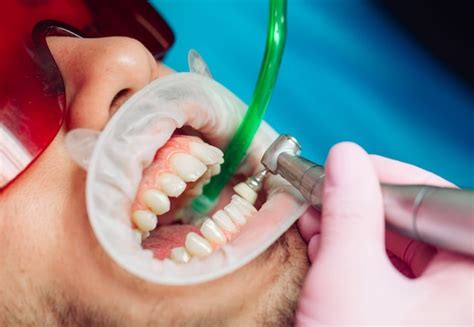 Limpieza Dental Profesional El Dentista Limpia Los Dientes De Un
