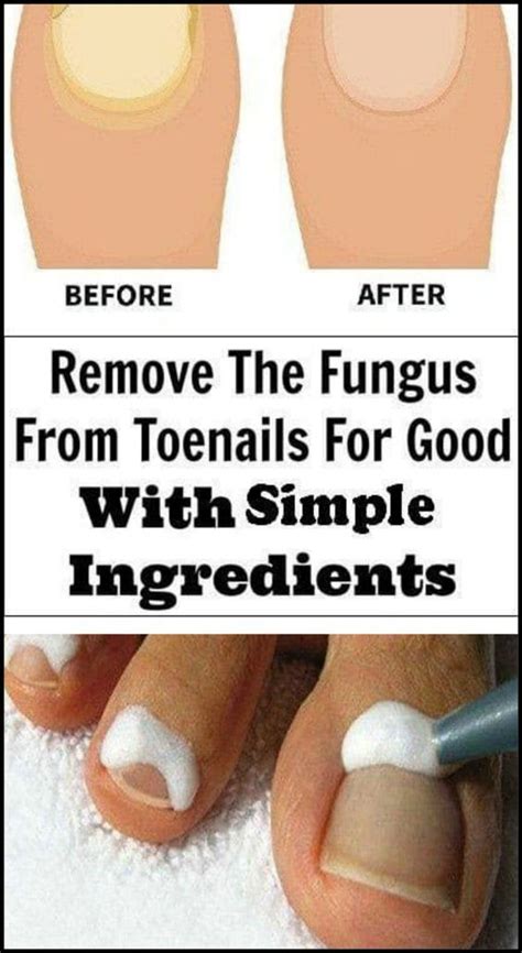 Here Are The 9 Ways To Remove The Fungus From Toenails For Good With