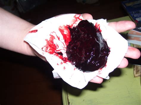 Ras Clot Marys Blood Clot 2 3 Days After The Birth The Jewish