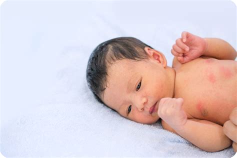 Kenali 7 Jenis Ruam Pada Bayi Dan Cara Mengatasinya