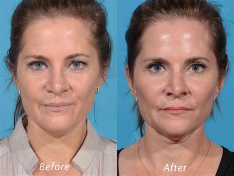 One Kit 5 Syringes Bellafill As A Liquid Facelift To Completely