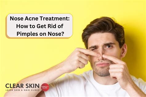 Nose Acne Treatment How To Get Rid Of Pimples On Nose