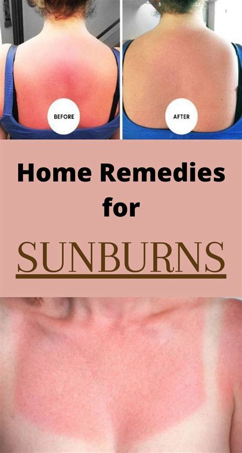 How To Get Rid Of Sunburns Fast With Home Remedies And Treatments