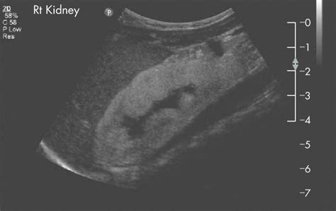 Renal Ultrasound Showed Bilateral Globally Echogenic Kidneys With Some