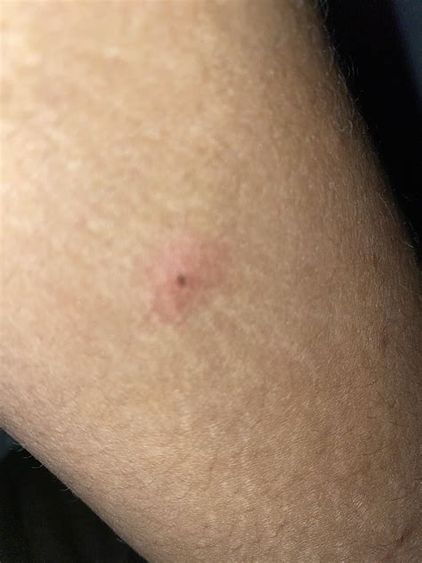 So I Just Noticed This Bump Today On My Skin Its Under A Moledark
