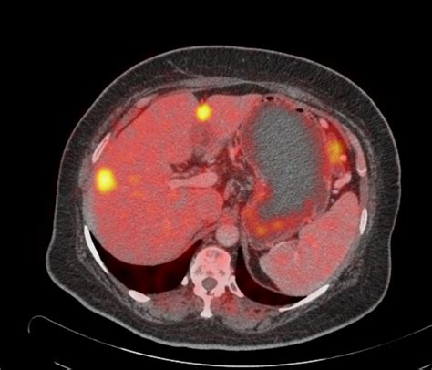 Petct Cancer Pancreas With Liver Metastases Radrounds Radiology Network