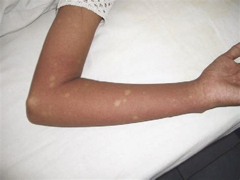 Endemic in tropical and subtropical countries convalescent phase: Dengue rash with sparing of small islands of normal skin ...