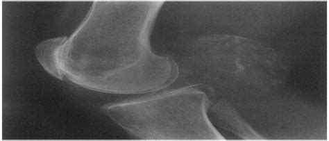 Baker Cyst Calcifications In A Patient With Rheumatoid Arthr Jcr